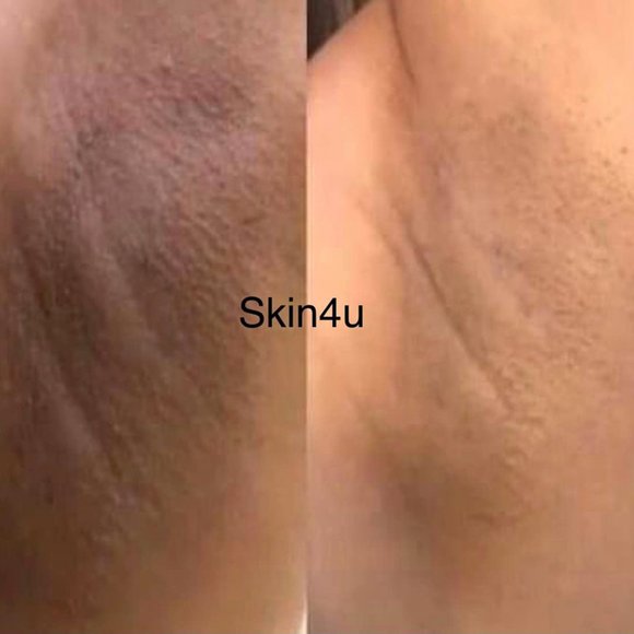 Anti acne whitening soap - Picture 3 of 7